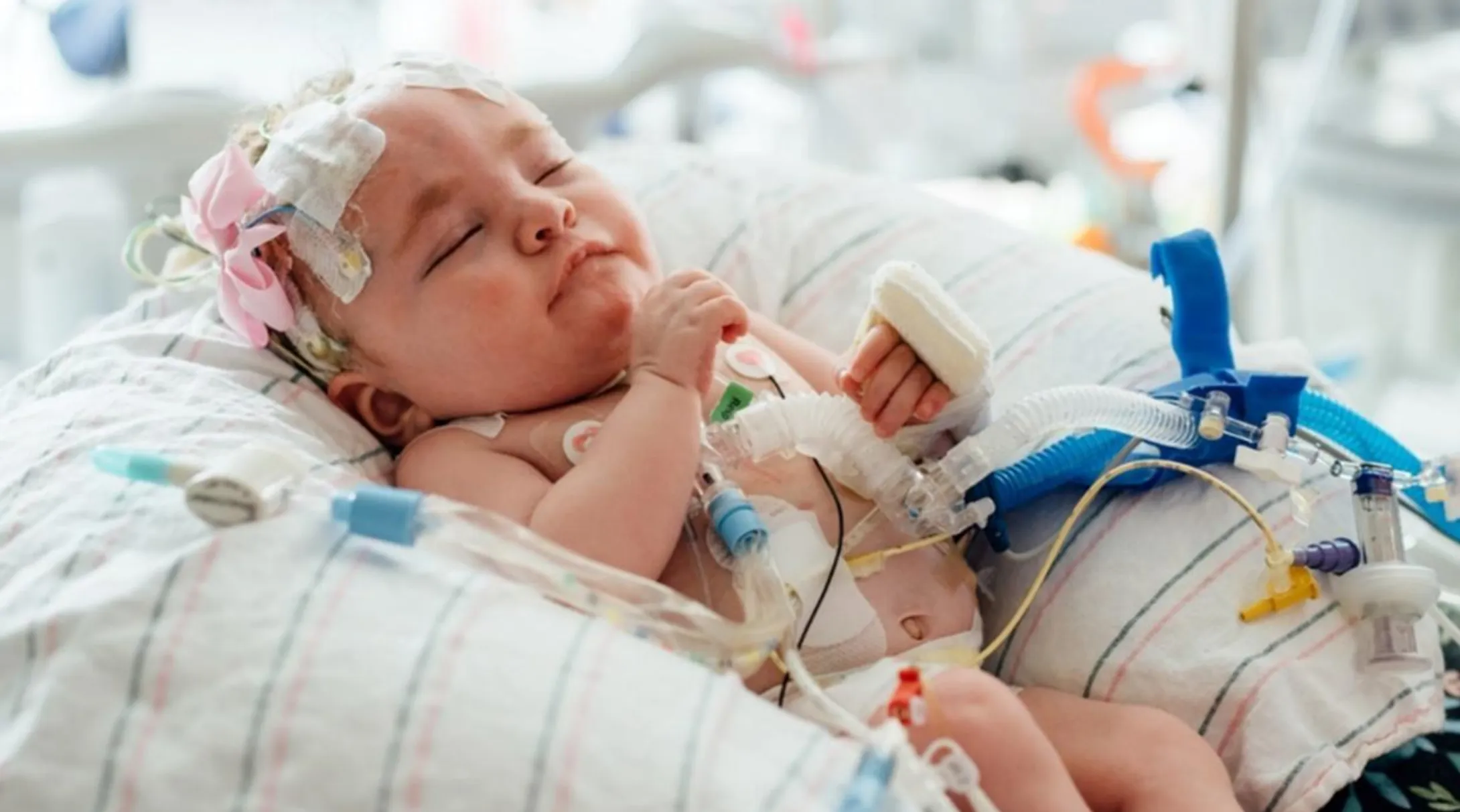 A tiny baby, Kennedy, on a pillow with a bow in her hair, hooked up to medical equipment