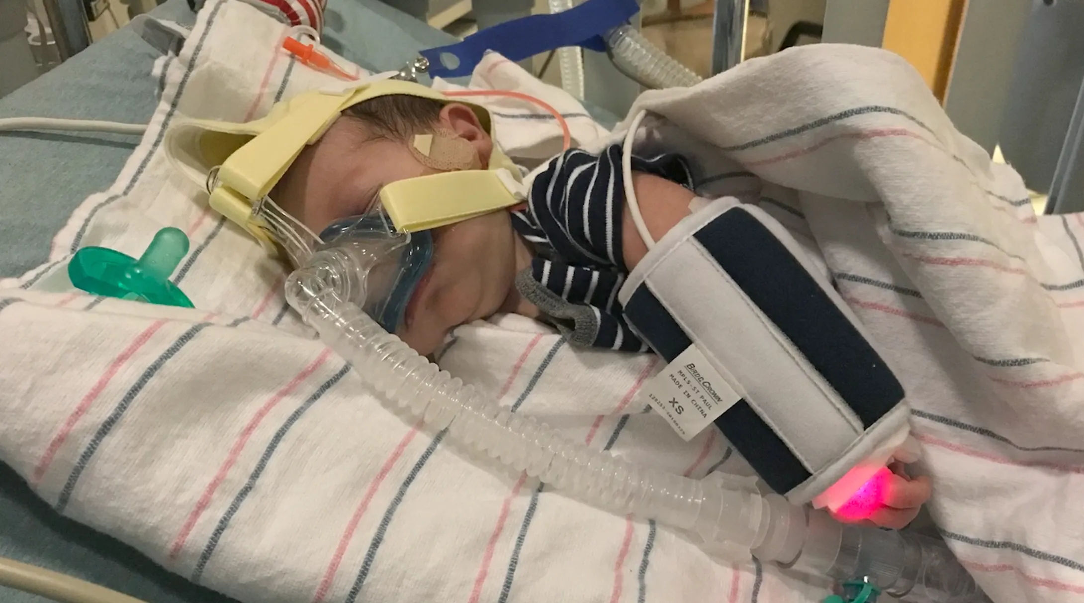 Nate, a Boston Children's Hospital patient, being treated as a baby